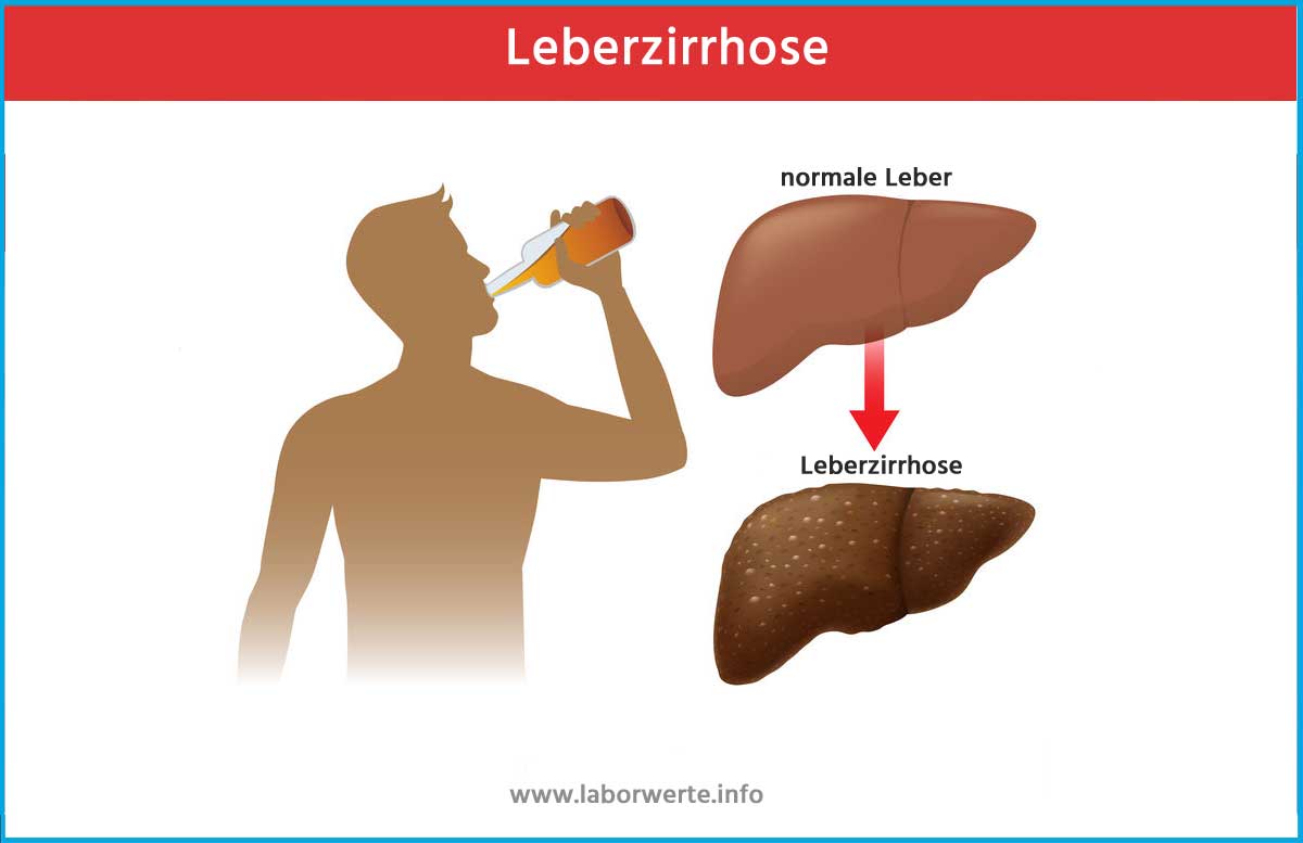 Was Darf Man Nicht Essen Bei Leberzirrhose www.laborwerte.info