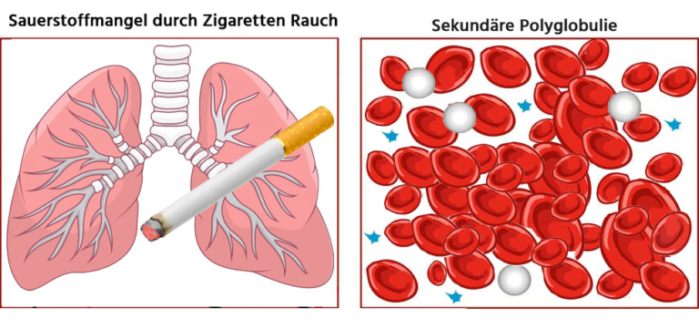 ᐅ Polyglobulie (erhöhte Hämoglobinkonzentration), Ursachen & Symptome